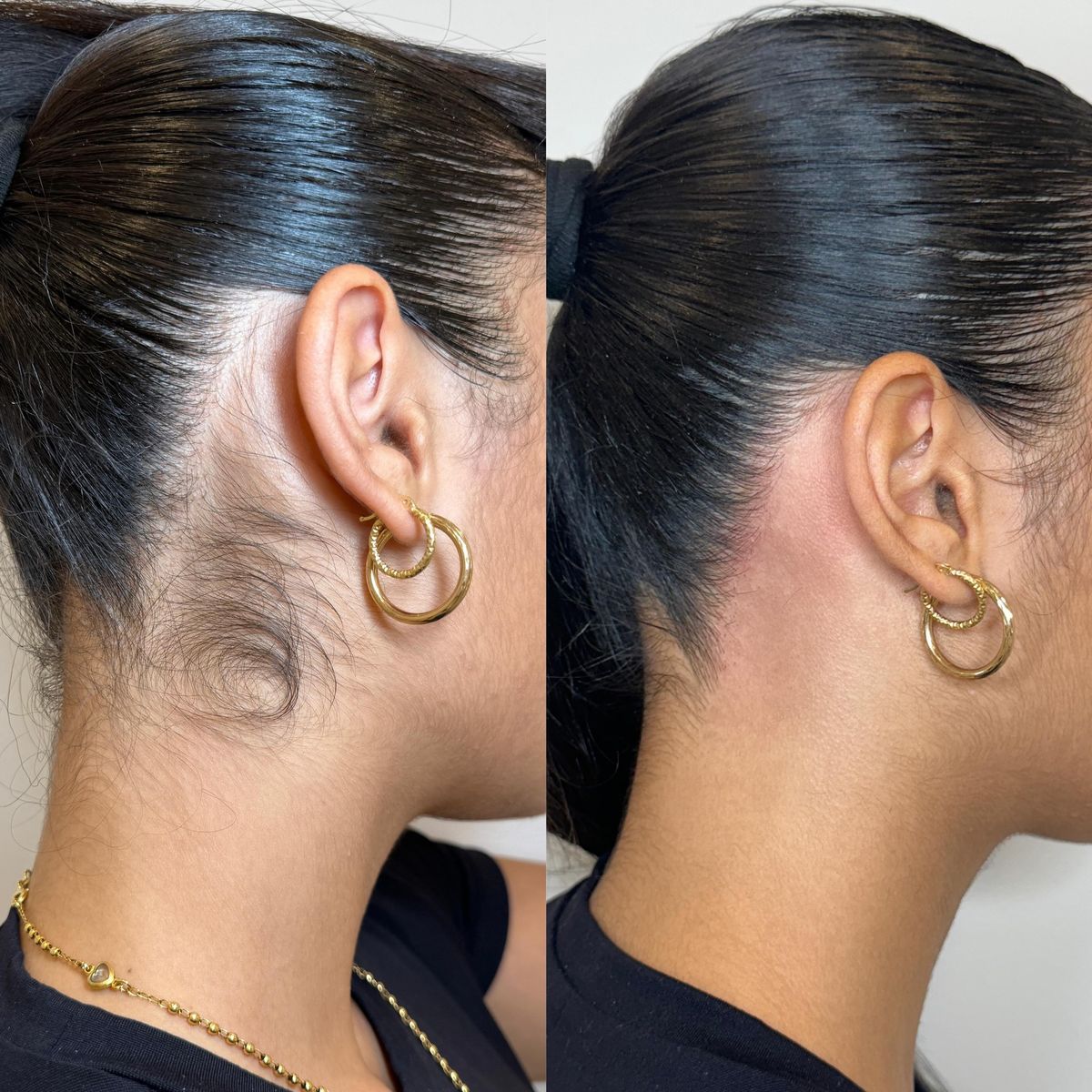 Neck & hairline