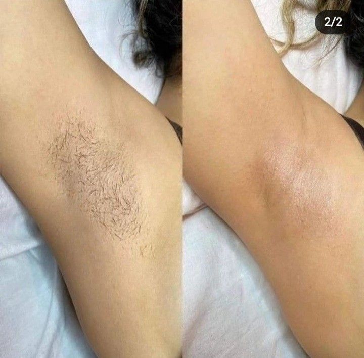 Underarms